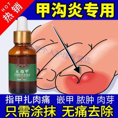 岐甲沟净岐甲沟净甲勾焱专用嵌甲膏软甲指甲长肉里灰甲沟康肉芽出脓